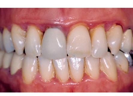 picture of periodontitis