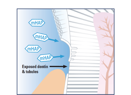 illustration of exposed dentin and tubules