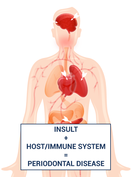 body illustration saying insult plus immune system equals periodontal disease