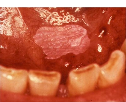oral lesions in mouth