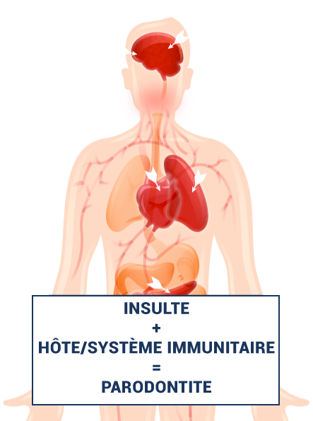 body illustration saying insult plus immune system equals periodontal disease